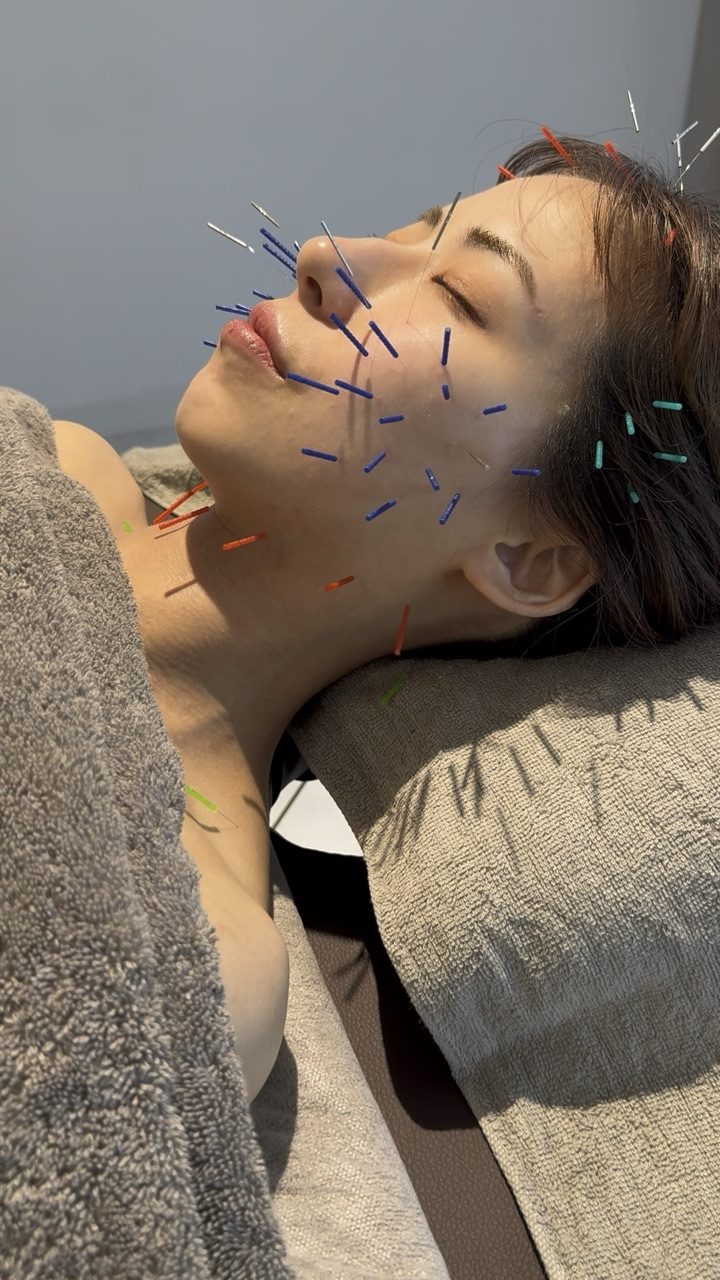 美容鍼の施術